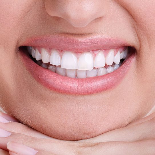porcelain veneers