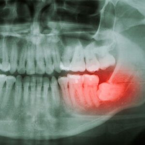 wisdom teeth removal wisdom tooth removal