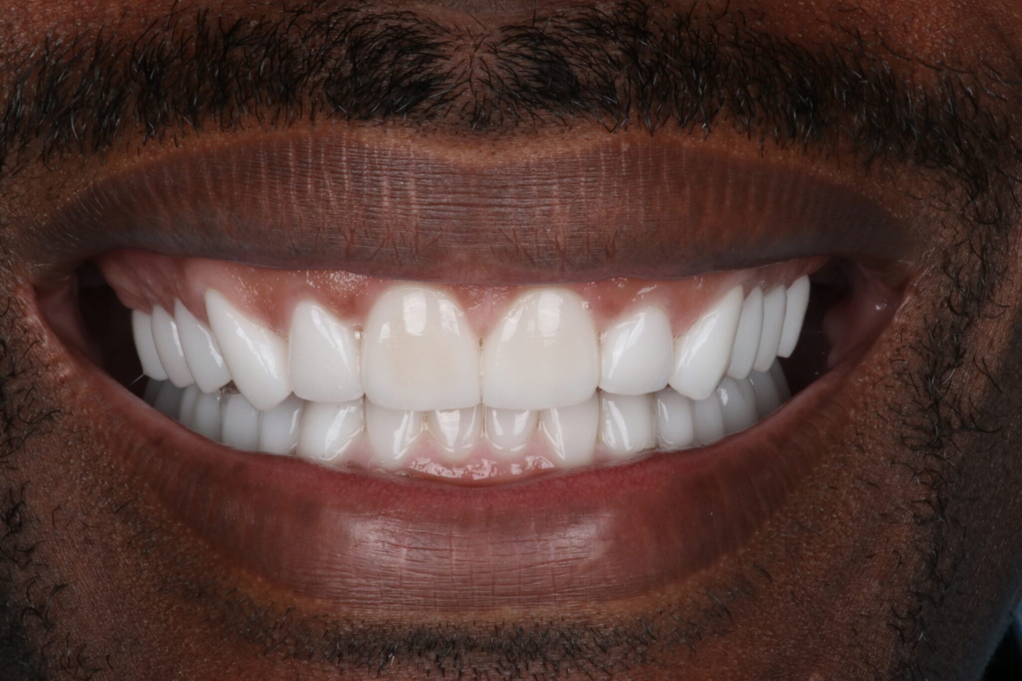 After-Closed Smile (1)