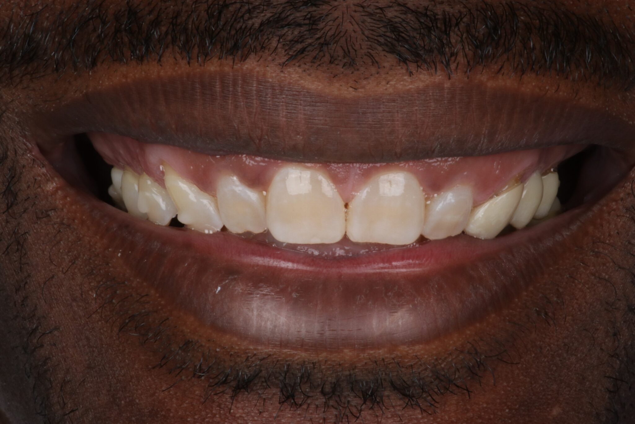 Before Upper Smile (1)