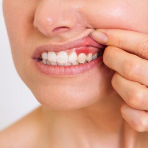 gum disease dental cleaning