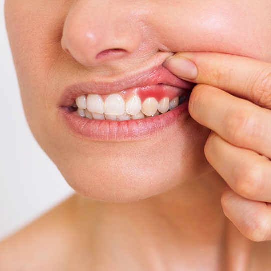 gum disease dental cleaning
