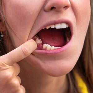 dental implants
